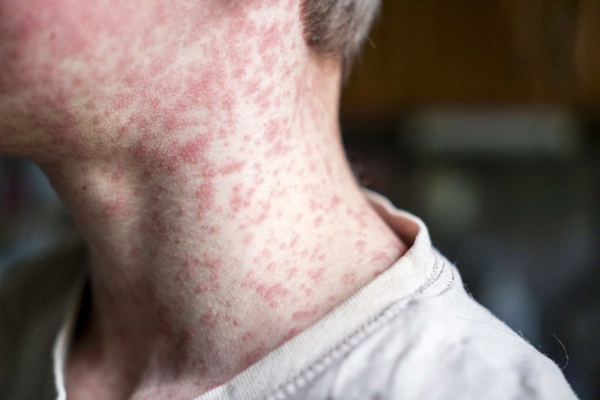 Dermatologist For Rashes Hertfordshire | Medi-Derm Clinic