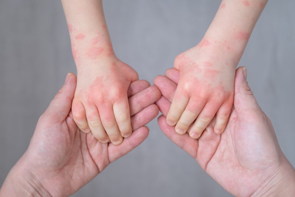 dermatologist-for-eczema-child