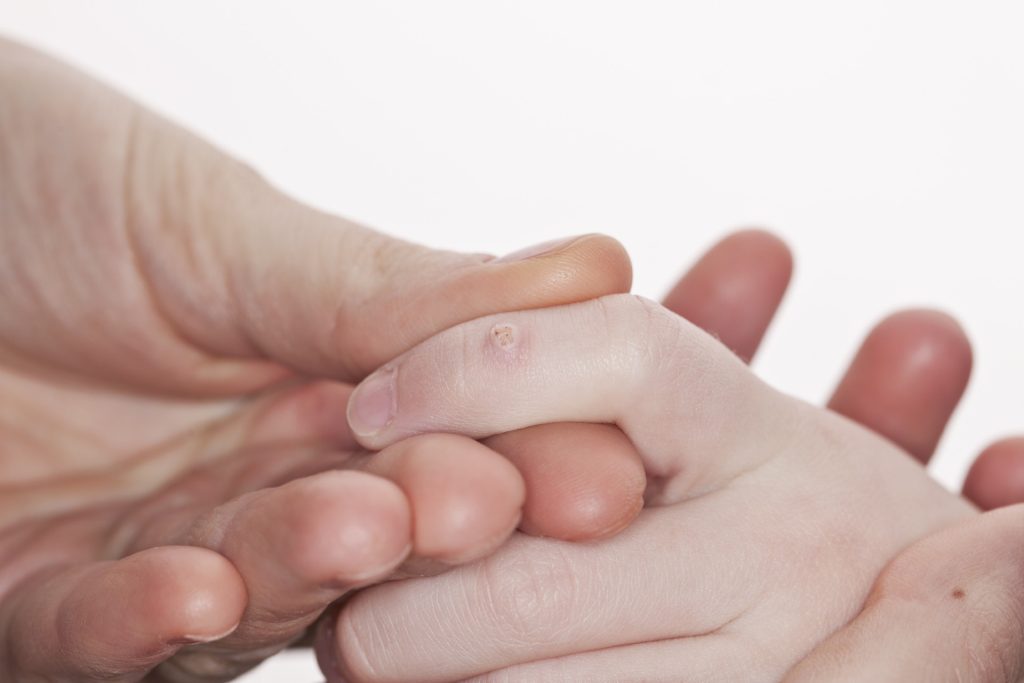 dermatologist-for-warts-hertfordshire-mediderm