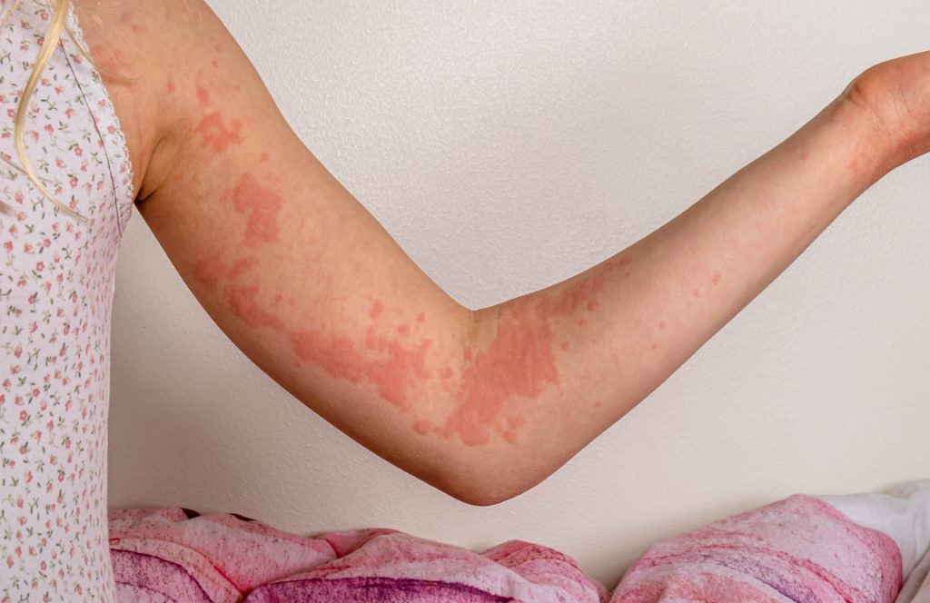 dermatologist-for-hives-in-hertfordshire