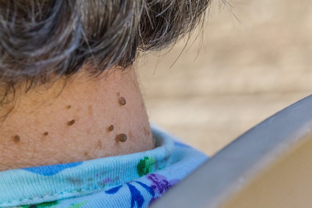 dermatologist-for-skin-tags-in-hertfordshire