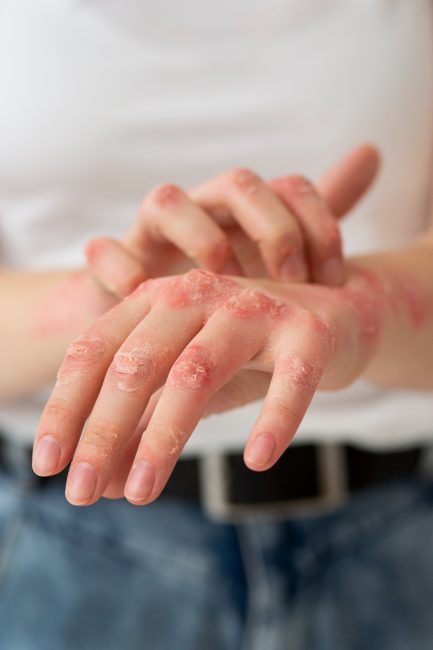 dermatitis-img
